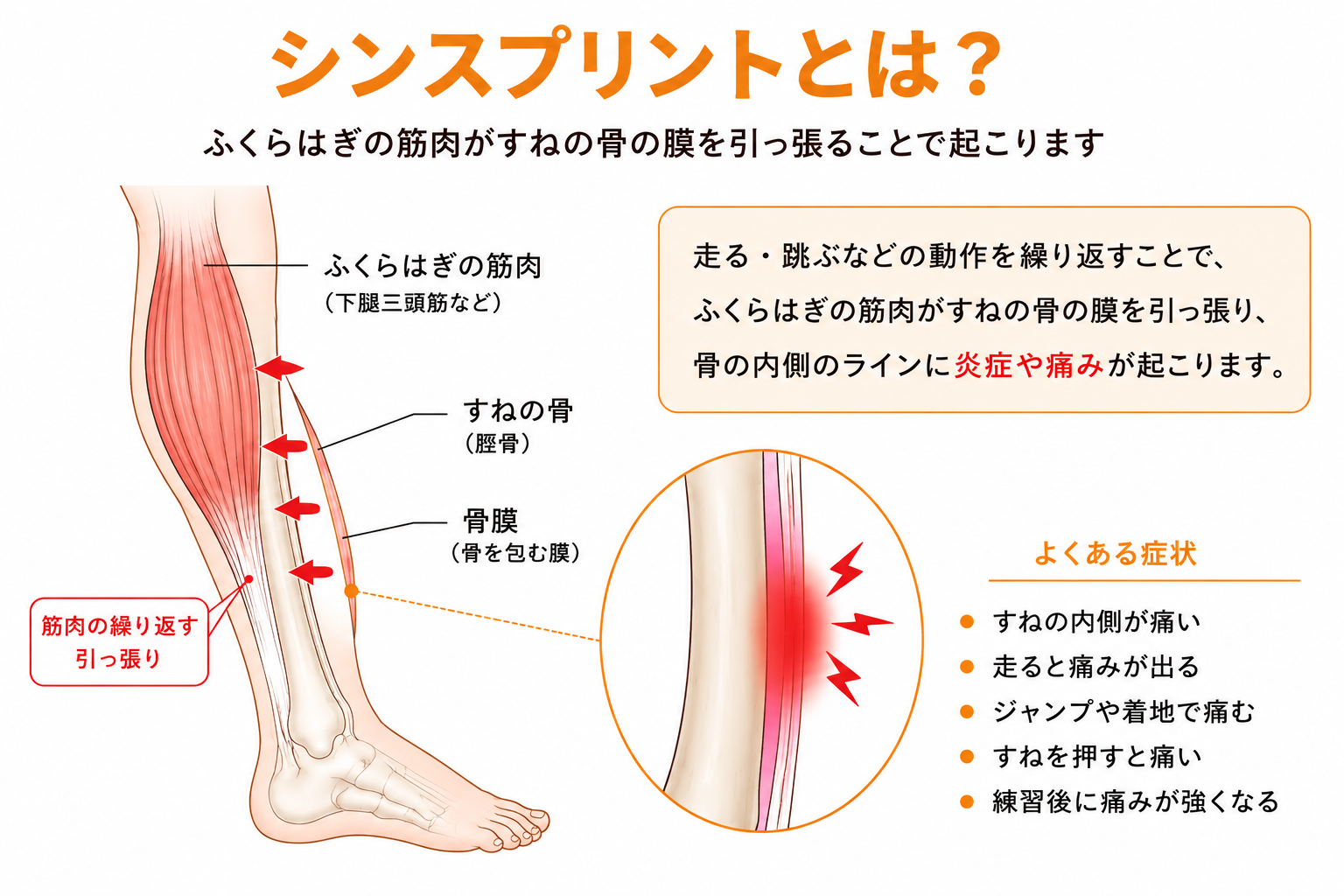 シンスプリント（脛骨過労性骨膜炎）とは